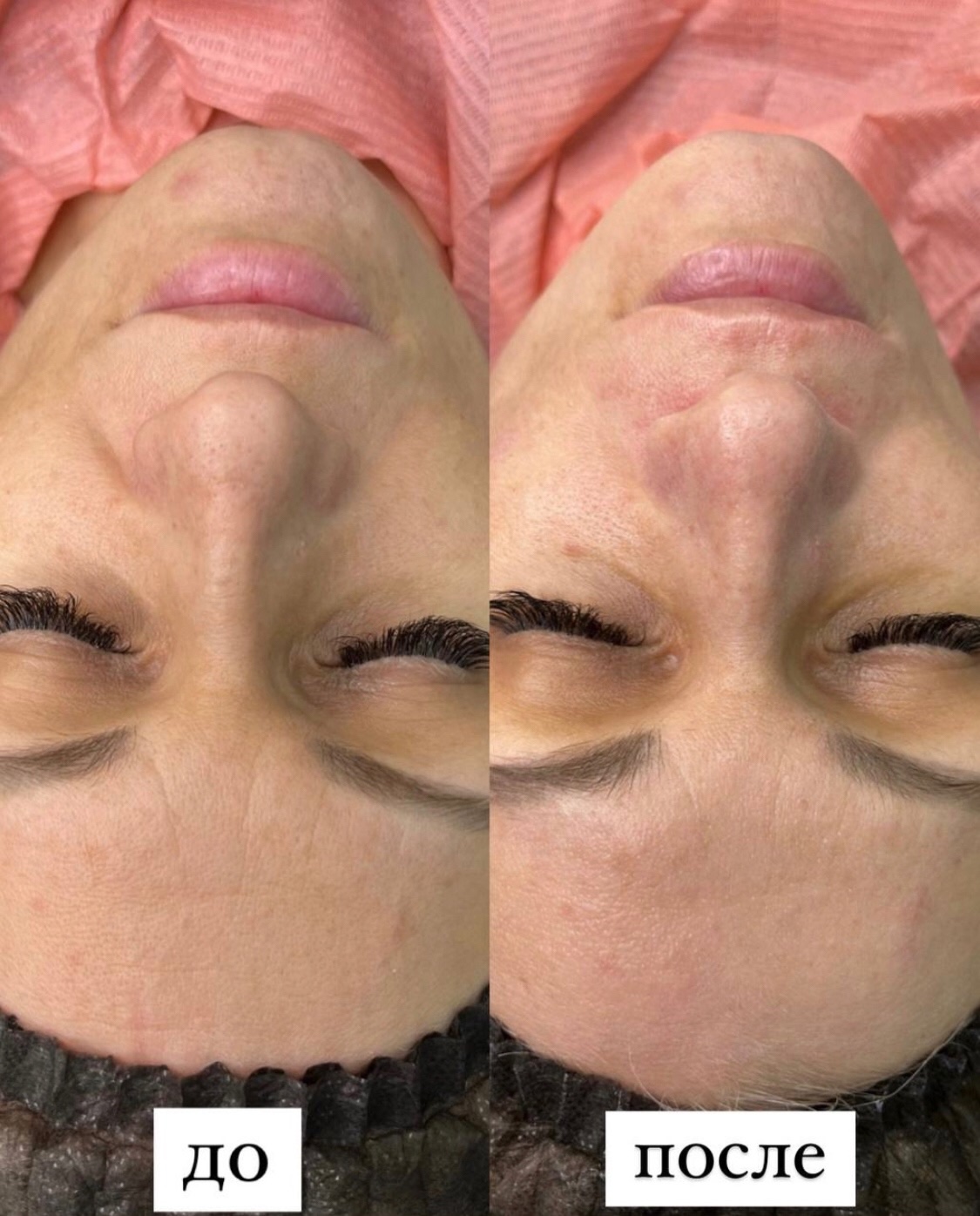 Ультразвуковая чистка и углеродное омоложение 1 процедура